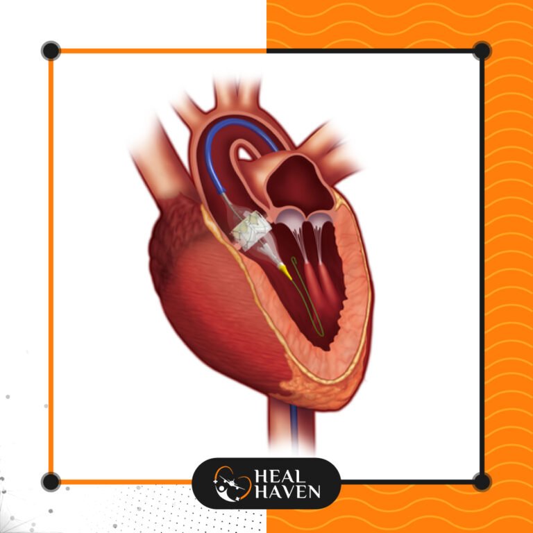Read more about the article استبدال الصمام الابهري