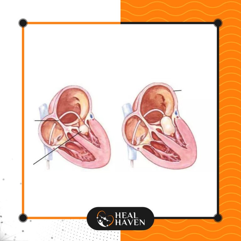 Read more about the article استبدال صمامات القلب