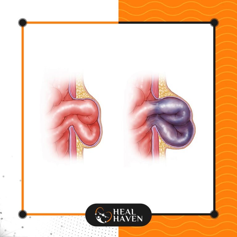 Read more about the article رتق الأمعاء