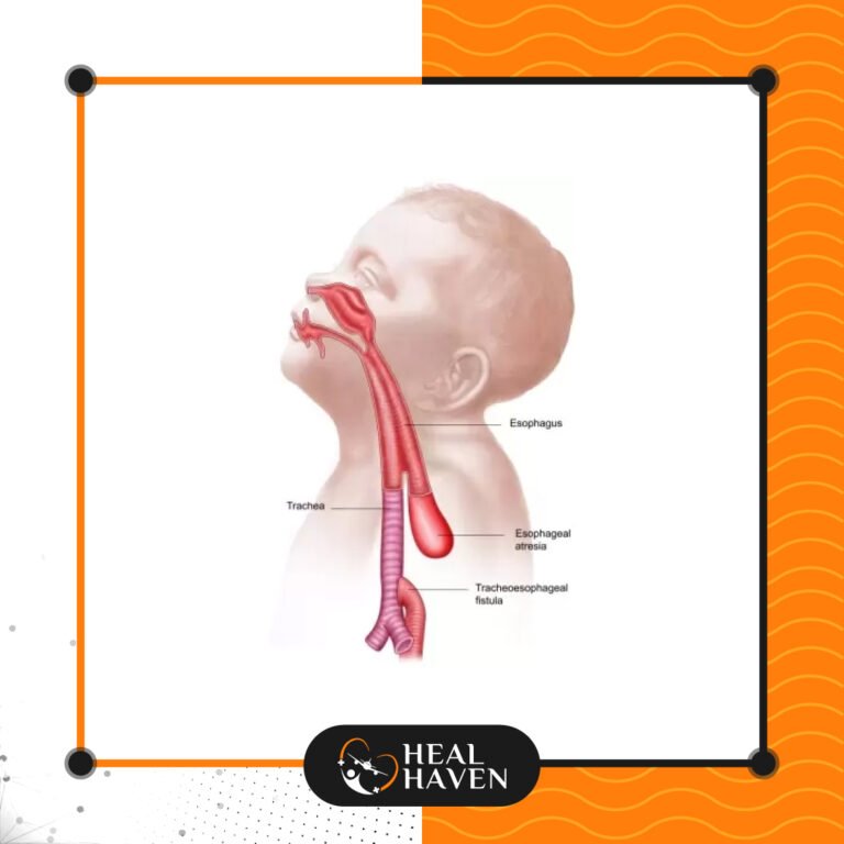 Read more about the article رتق المريء والناسور الرغامي
