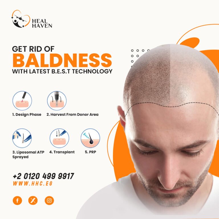 Read more about the article لمحة عامة عن زراعة الشعر